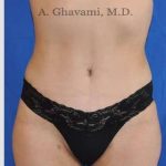 Abdominoplasty Before & After Patient #8200
