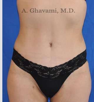 Abdominoplasty Before & After Patient #8200