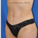 Abdominoplasty Before & After Patient #8200
