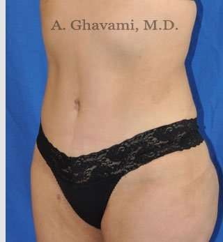 Abdominoplasty Before & After Patient #8200