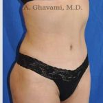 Abdominoplasty Before & After Patient #8200