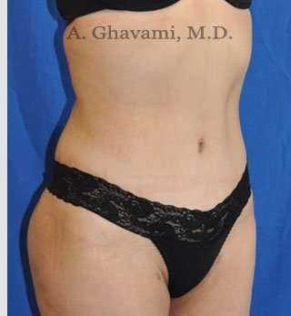 Abdominoplasty Before & After Patient #8200