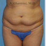 Abdominoplasty Before & After Patient #8200