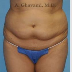 Abdominoplasty Before & After Patient #8200
