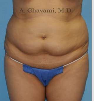 Abdominoplasty Before & After Patient #8200
