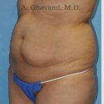 Abdominoplasty Before & After Patient #8200