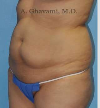 Abdominoplasty Before & After Patient #8200