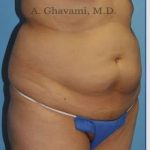 Abdominoplasty Before & After Patient #8200