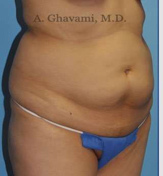 Abdominoplasty Before & After Patient #8200
