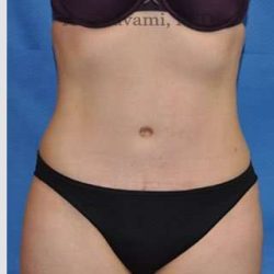 Abdominoplasty Before & After Patient #8193
