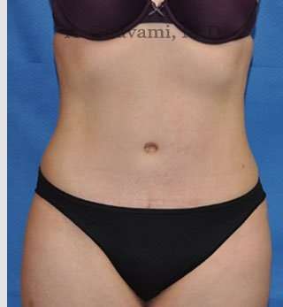 Abdominoplasty Before & After Patient #8193