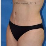 Abdominoplasty Before & After Patient #8193
