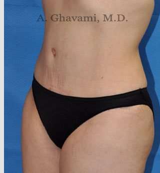 Abdominoplasty Before & After Patient #8193