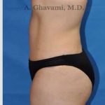 Abdominoplasty Before & After Patient #8193