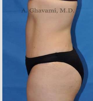 Abdominoplasty Before & After Patient #8193