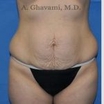 Abdominoplasty Before & After Patient #8193