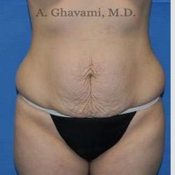 Abdominoplasty Before & After Patient #8193