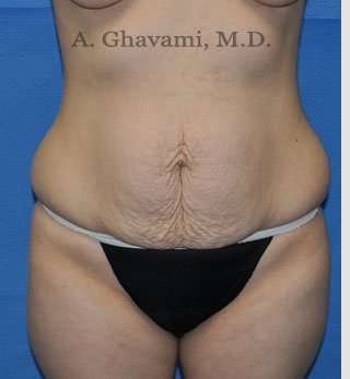 Abdominoplasty Before & After Patient #8193