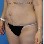 Abdominoplasty Before & After Patient #8193
