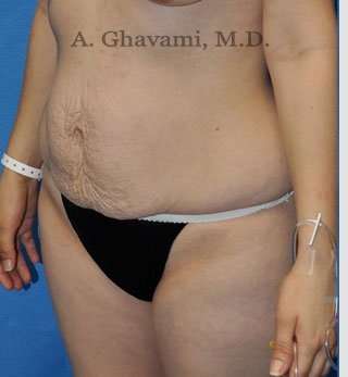 Abdominoplasty Before & After Patient #8193