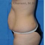 Abdominoplasty Before & After Patient #8193