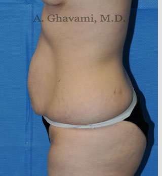Abdominoplasty Before & After Patient #8193