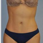 Abdominoplasty Before & After Patient #8186