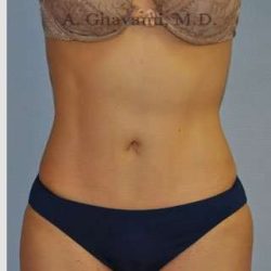 Abdominoplasty Before & After Patient #8186