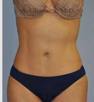 Abdominoplasty Before & After Patient #8186