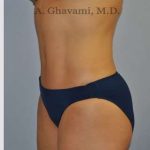 Abdominoplasty Before & After Patient #8186