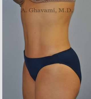 Abdominoplasty Before & After Patient #8186