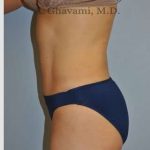 Abdominoplasty Before & After Patient #8186