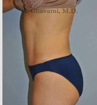 Abdominoplasty Before & After Patient #8186