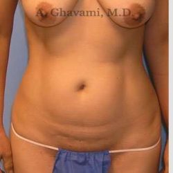 Abdominoplasty Before & After Patient #8186