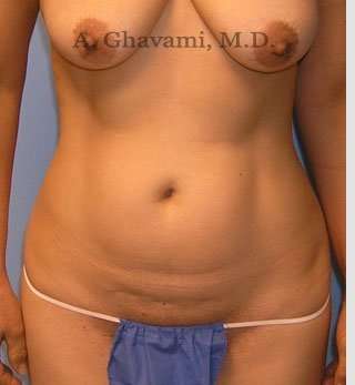 Abdominoplasty Before & After Patient #8186