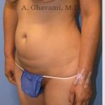 Abdominoplasty Before & After Patient #8186