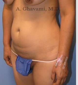 Abdominoplasty Before & After Patient #8186