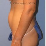 Abdominoplasty Before & After Patient #8186