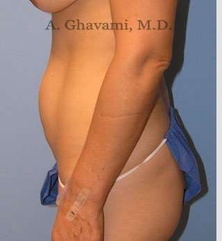 Abdominoplasty Before & After Patient #8186