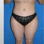 Abdominoplasty Before & After Patient #8179