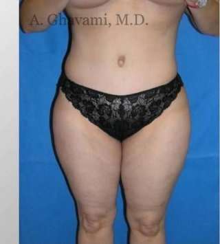 Abdominoplasty Before & After Patient #8179