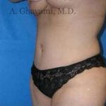 Abdominoplasty Before & After Patient #8179