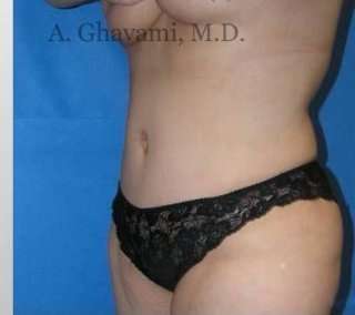 Abdominoplasty Before & After Patient #8179