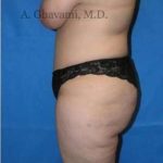 Abdominoplasty Before & After Patient #8179
