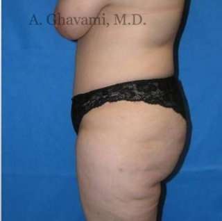 Abdominoplasty Before & After Patient #8179