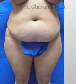 Abdominoplasty Before & After Patient #8179