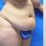 Abdominoplasty Before & After Patient #8179