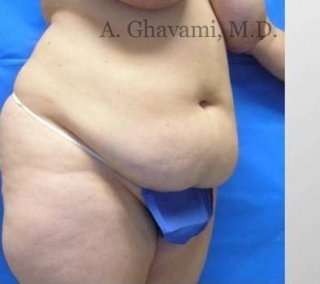 Abdominoplasty Before & After Patient #8179