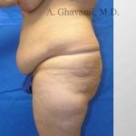 Abdominoplasty Before & After Patient #8179