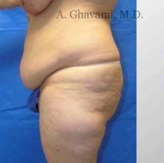 Abdominoplasty Before & After Patient #8179